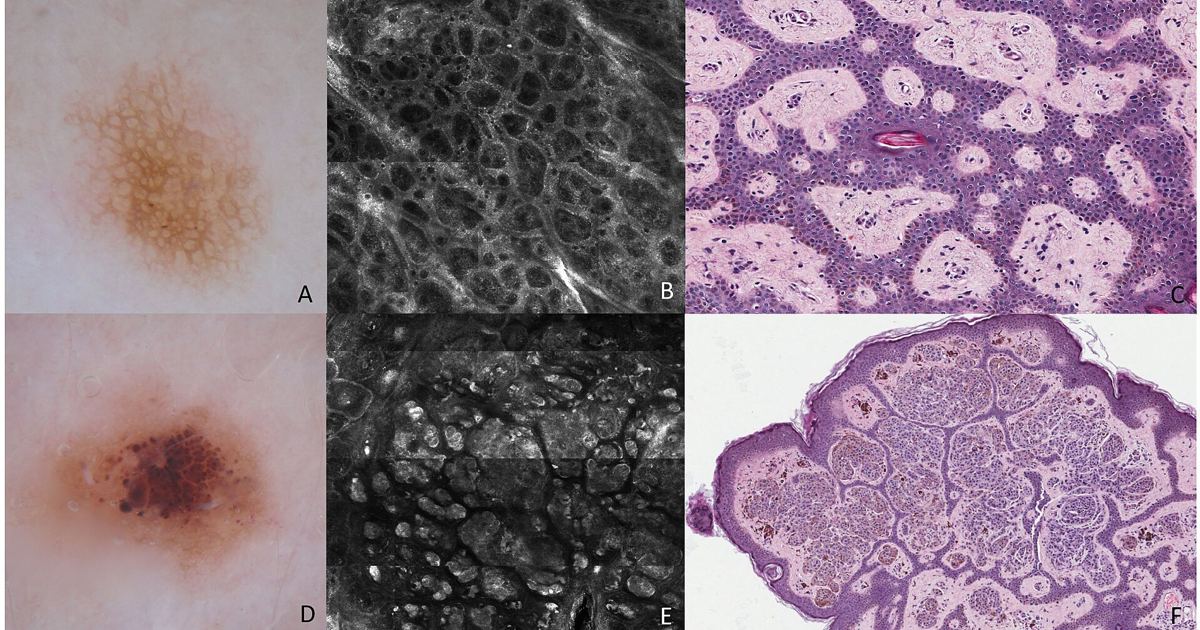 Drug-Induced Eruptive Nevi: What a 2017 Review Discovered