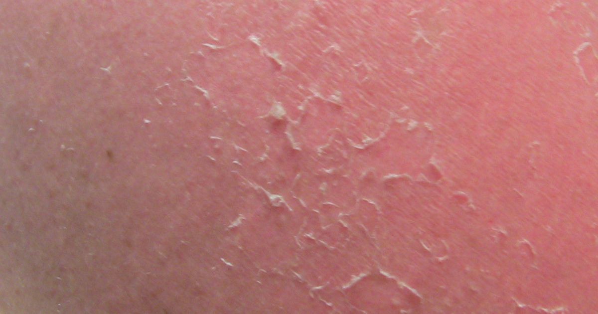 Sunburn and Peeling Timeline: Myths vs. Clinical Evidence