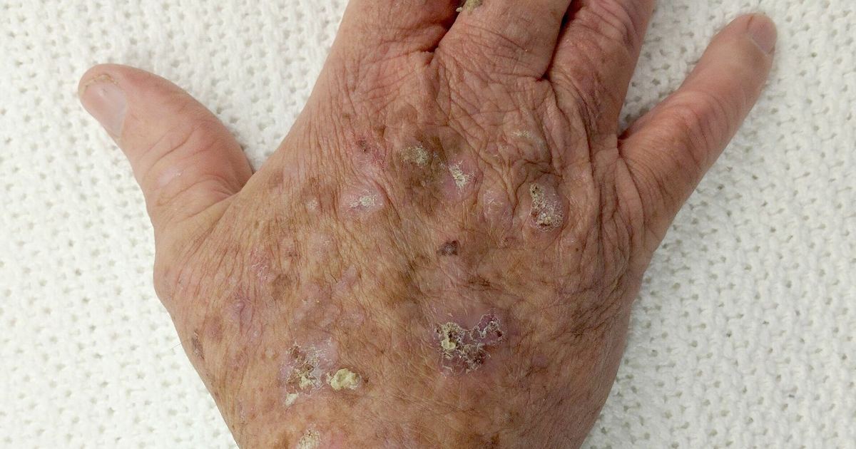 Squamous Cell Cancer and Sun Damage: Clinical FAQ