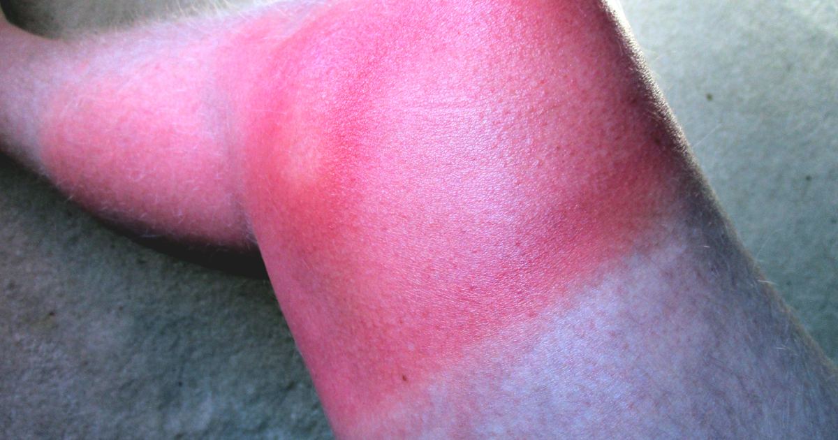 Sunburn Timing and Melanoma Risk: Comparing Life Stages