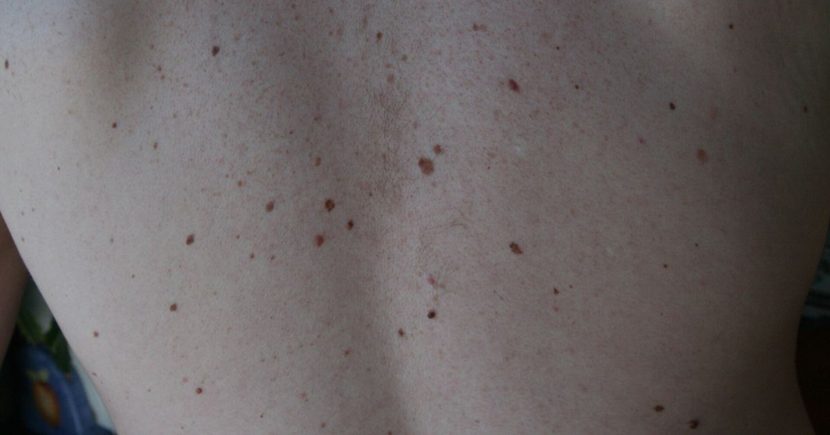 Atypical Moles and Melanoma Risk: 1996 Oncology Review Explained