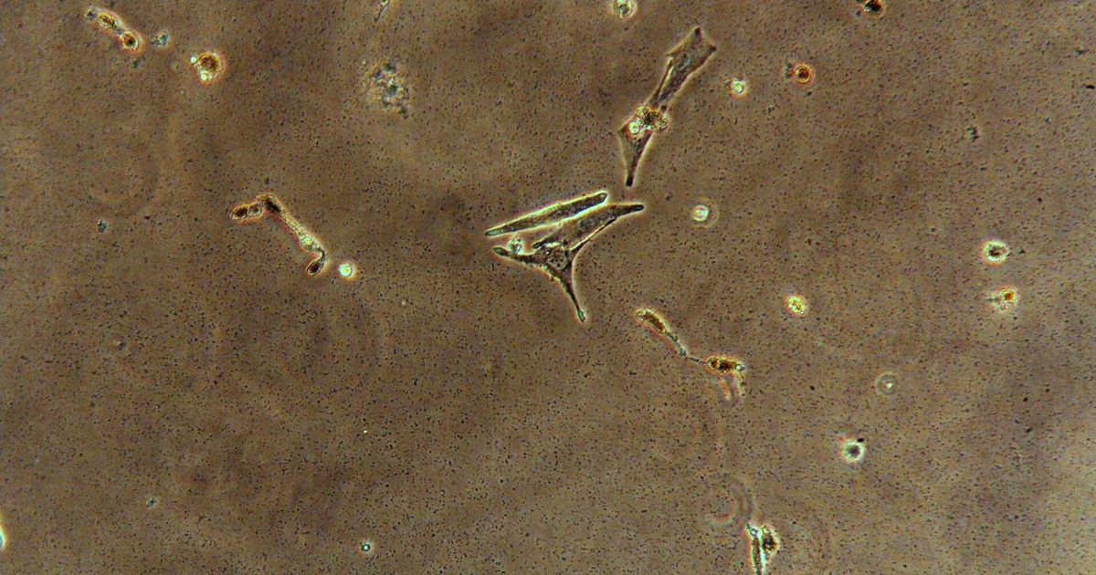 Melanocyte Cellular Changes: How Melanoma Begins and Grows
