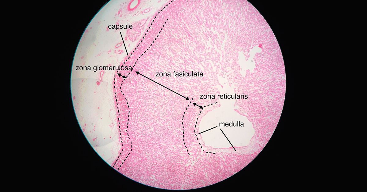 POMC Defects: Hypopigmentation and Endocrine Dysfunction