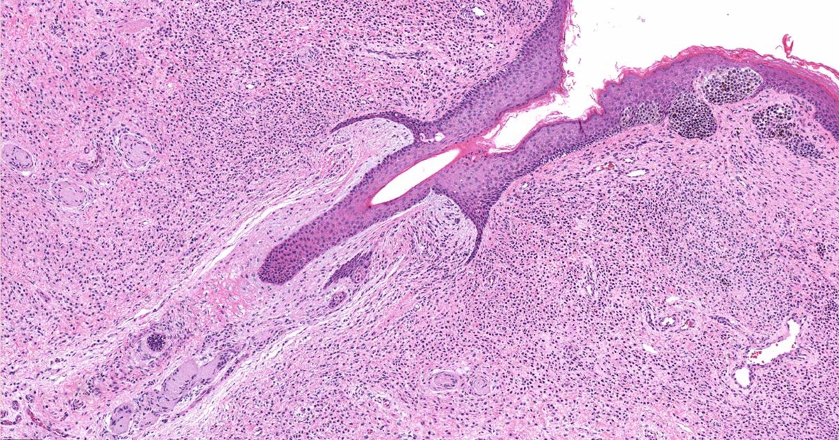 Giant Congenital Nevus: Monitoring and Melanoma Risks