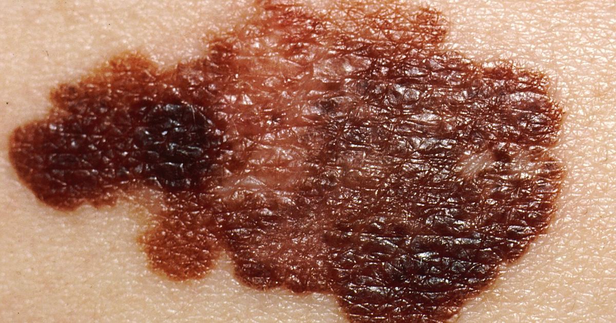 How UV Mutates Melanocyte DNA: Lessons from Clinical Melanoma Cases
