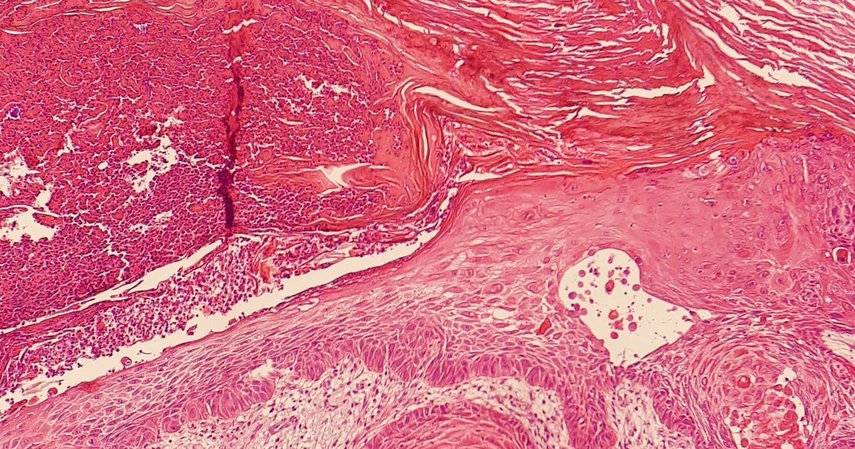 Scalp, Lips, and Hands: How Chronic Sun Causes Invasive SCC
