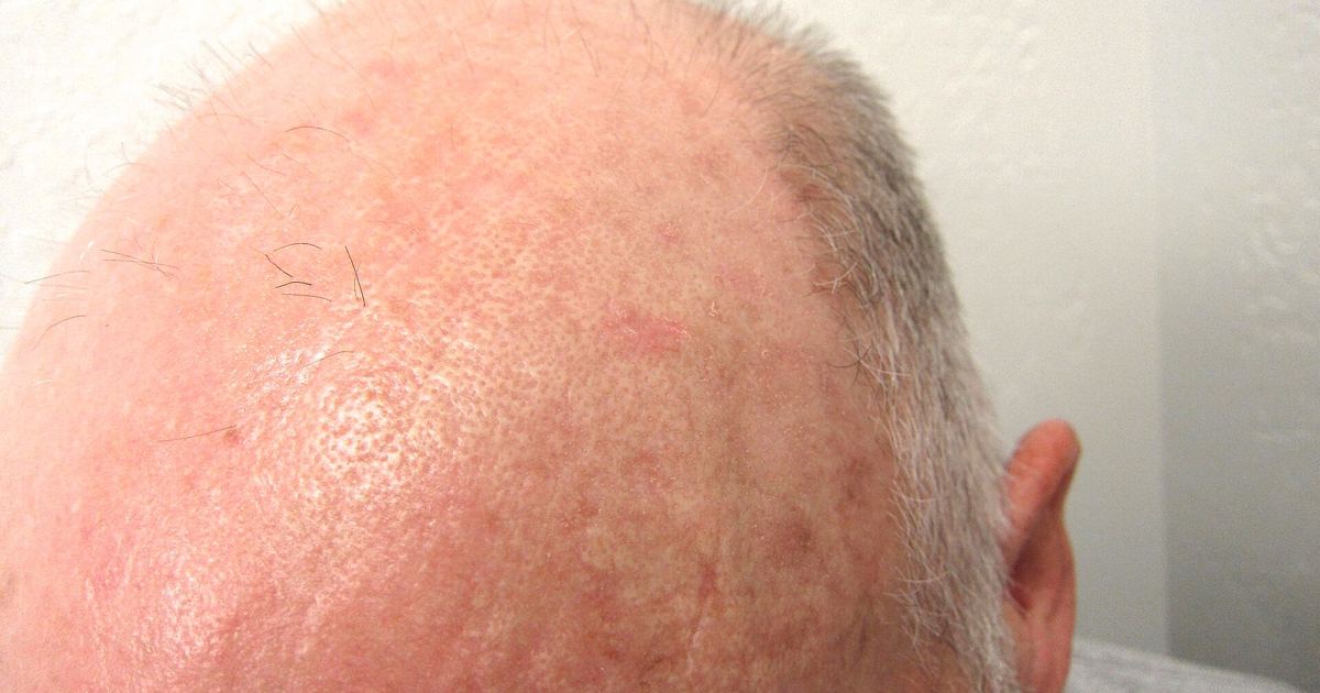 Actinic Keratosis: Why Precancerous Spots Need Clinical Care