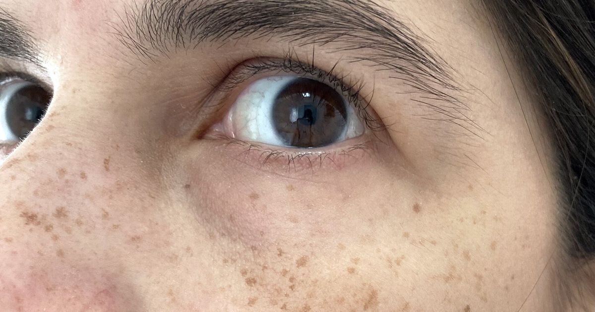 Sun Spots and "Age Spots" (Solar Lentigo): What They Are and When to Get One Checked