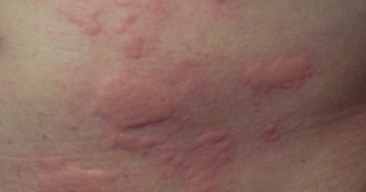 Solar Urticaria: When Sunlight Causes Hives Within Minutes
