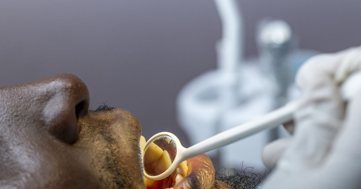 Afamelanotide and Darkened Gums: Myths vs. Clinical Evidence