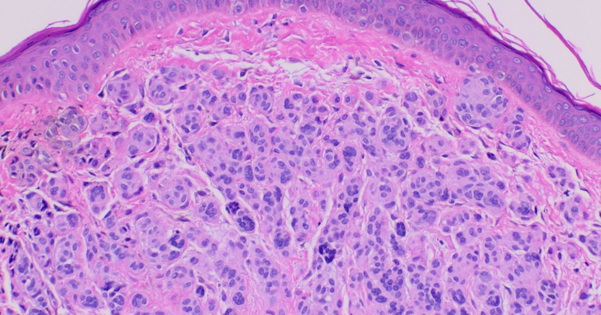 Melanocortin Receptor Research and Melanoma: Key Numbers